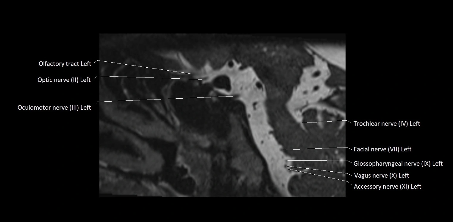 Cranial nerve sagittal anatomy MRI 3T image 24.webp